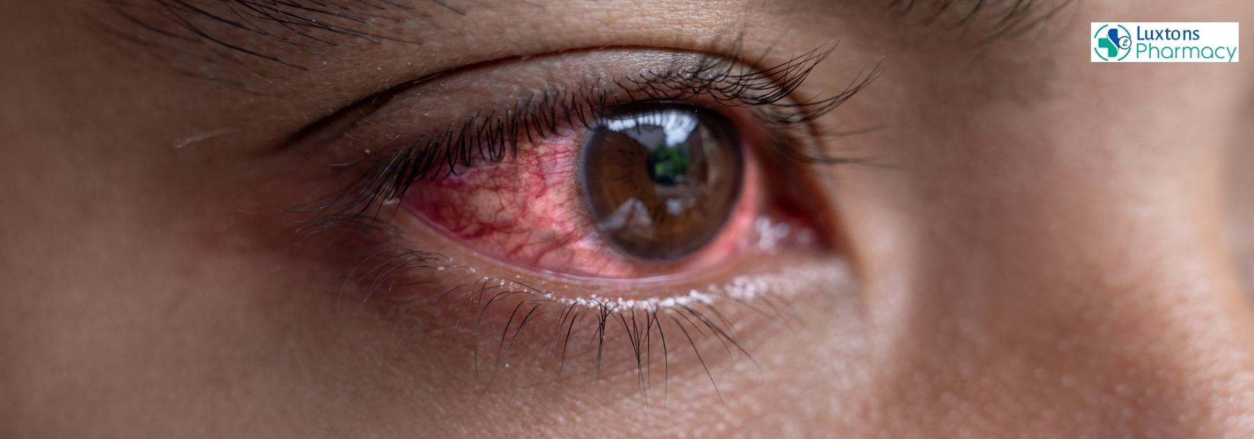 bloodshot eyes